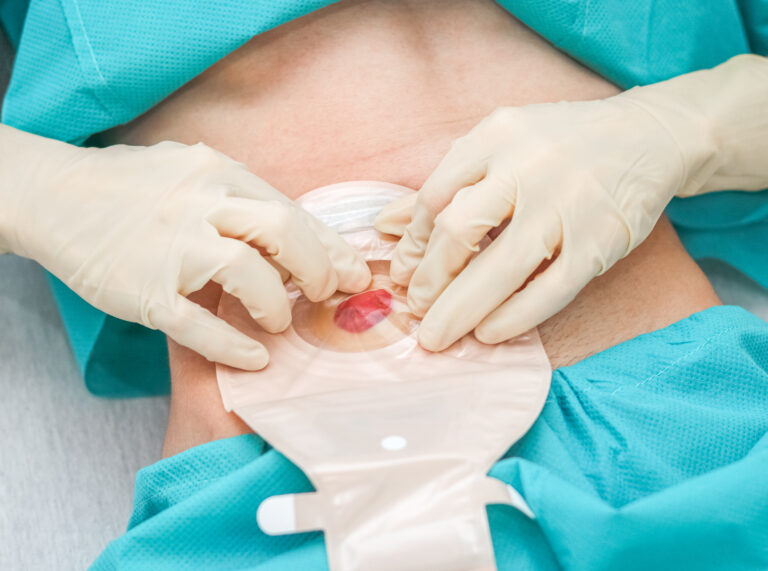 Ileostomia – dieta, pielęgnacja i życie ze stomią jelita cienkiego